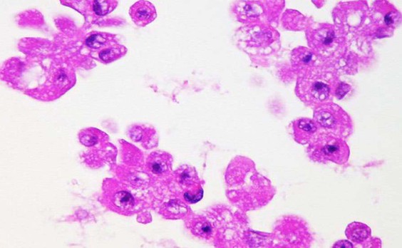 Интраоперационный соскоб с легкого, 5 день в ТПС-1, cell-block