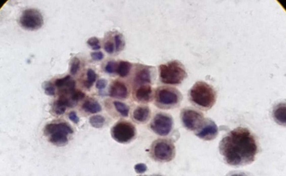 Осадок асцитической жидкости, ИЦХ (WT1)