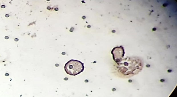 Циркулирующая опухолевая клетка, позитивная мембранная реакция на EpCAM. Пациентка 67 лет. Рак молочной железы II стадия.