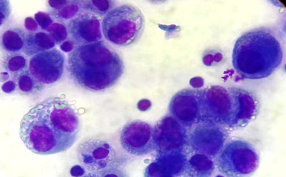 Осадок асцитической жидкости, ТПС-1, 3 день