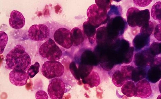 Интраоперационный соскоб с легкого, ТПС-1, 3 день