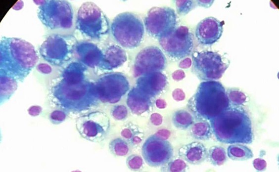 Осадок асцитической жидкости, ТПС-1, 9 день