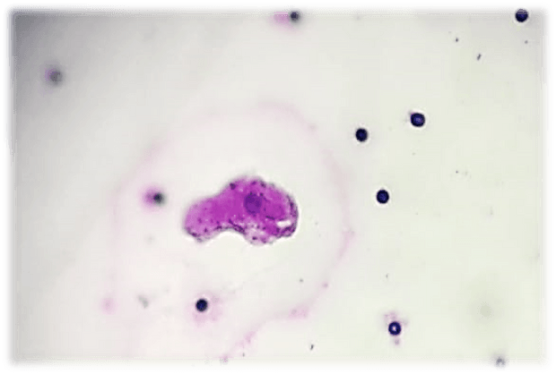 CAML. Пациентка 54 лет. Рак яичников  III стадия.