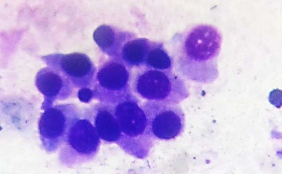 Интраоперационный соскоб с легкого, ТПС-1, 7 день