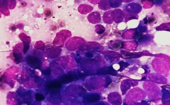 Интраоперационный соскоб с легкого до ТПС-1