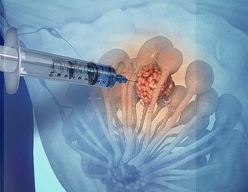 Получение материала при тонкоигольной аспирационной биопсии.