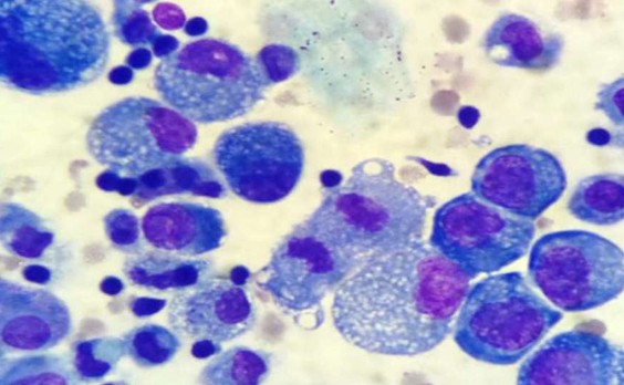 Осадок асцитической жидкости до ТПС-1